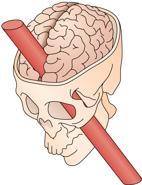 phineas gage case study answers